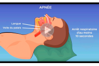 Apnée du sommeil : une journée de dépistage